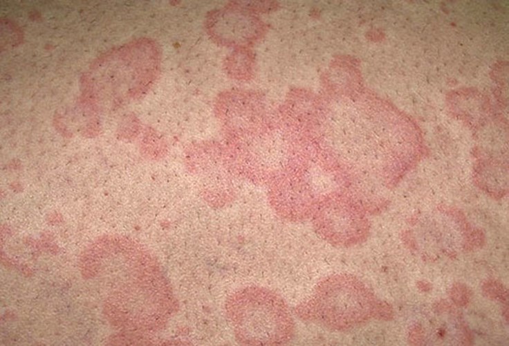 mẩn ngứa ngoài da tác hại khôn lường